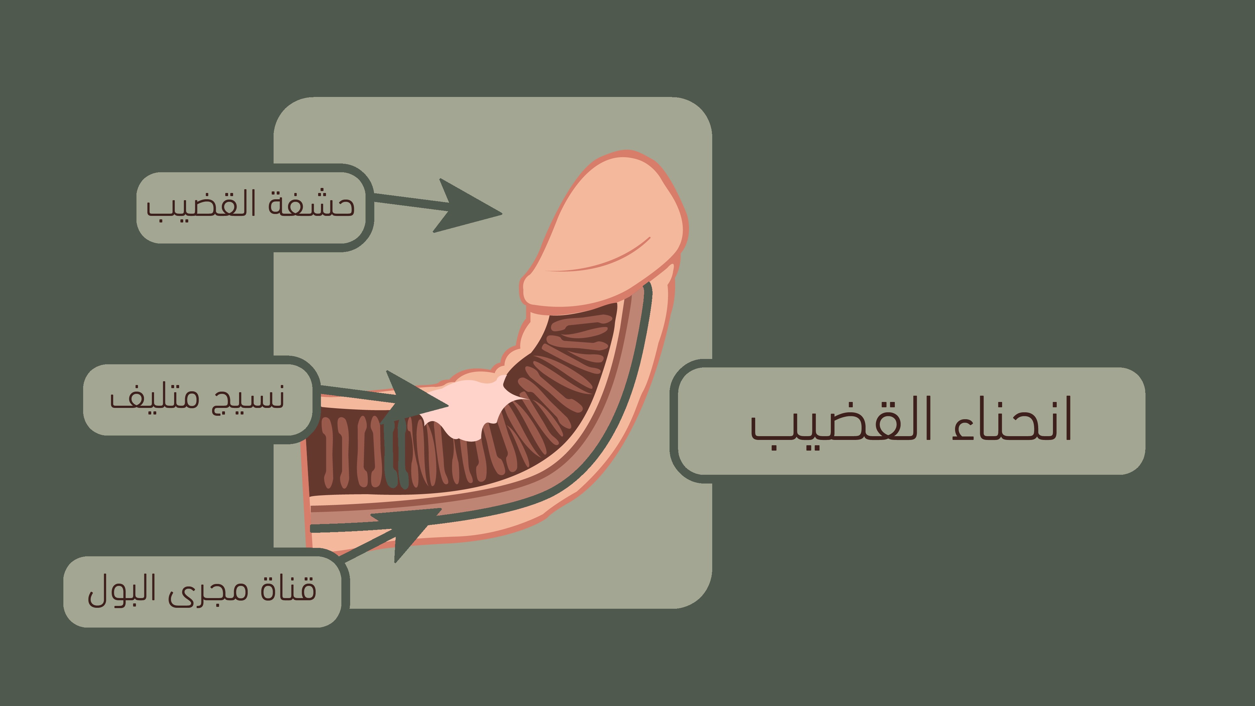 انحناء القضيب